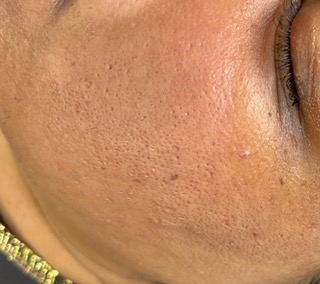 After Microneedling