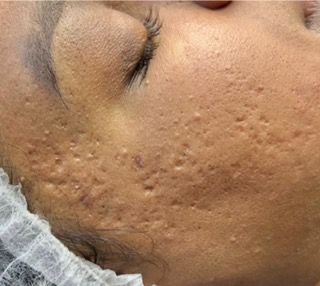 After Microneedling
