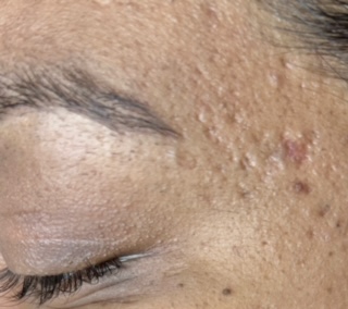 After Microneedling